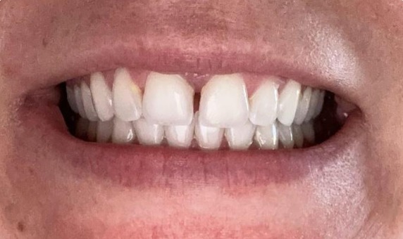 Sorriso com espaço entre os dentes da frente, antes do tratamento