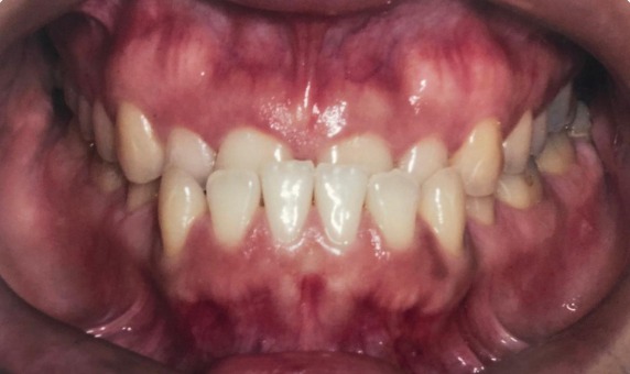 Dentes desalinhados antes do tratamento ortodôntico