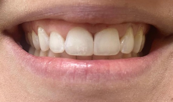 Sorriso após o fechamento do espaço entre os dentes