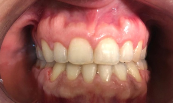 Dentes alinhados após o tratamento ortodôntico